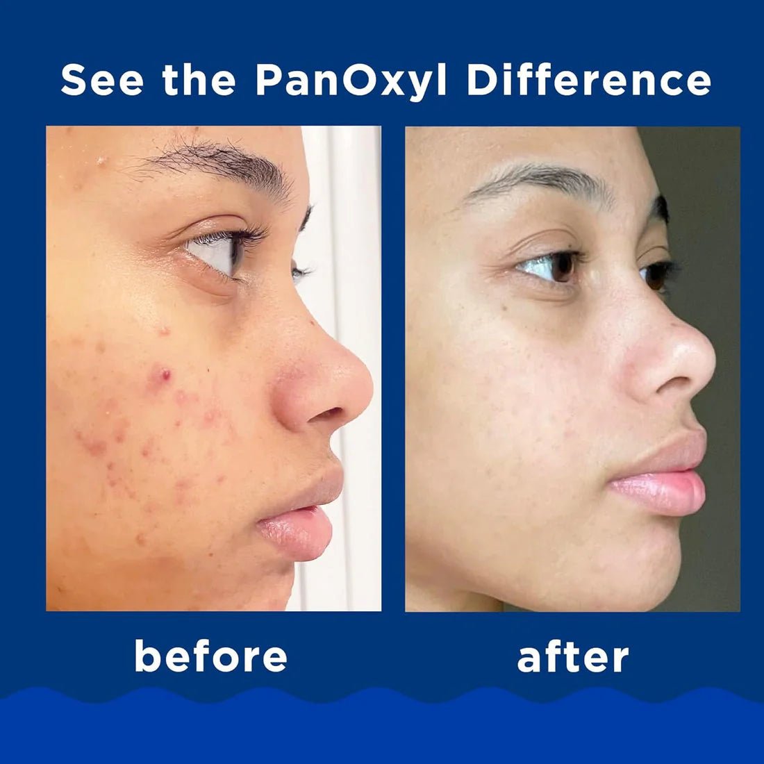 PanOxyl Acne Foaming Wash Benzoyl Peroxide 10% Maximum Strength (156g) - Beauty Icon - 