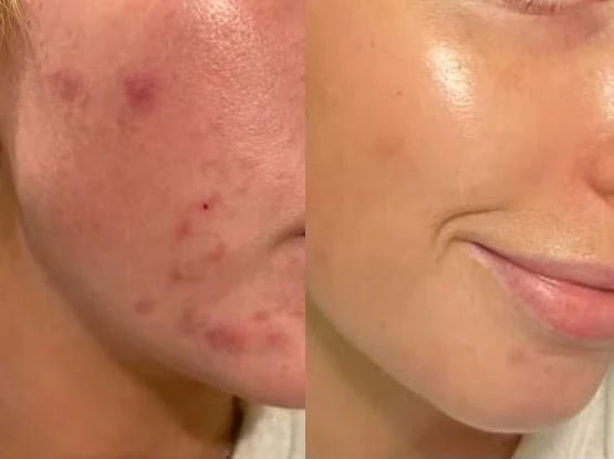 Paula's Choice Skin Perfecting 2% BHA Liquid Exfoliant - Beauty Icon - 